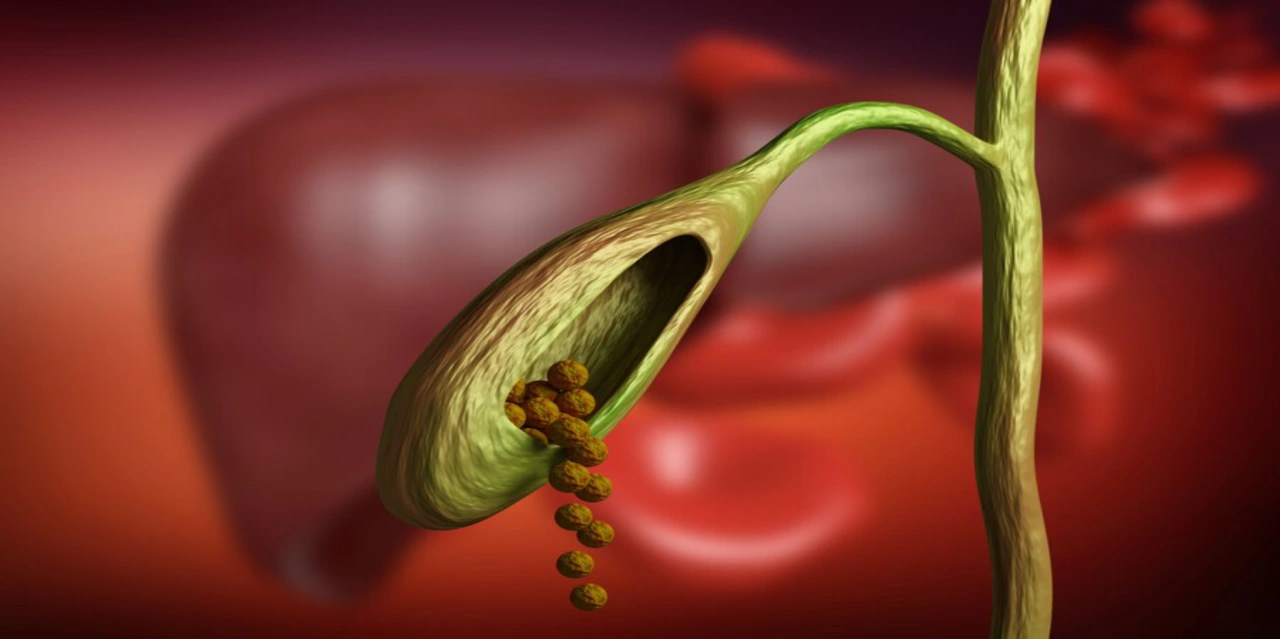 Gallbladder Stone