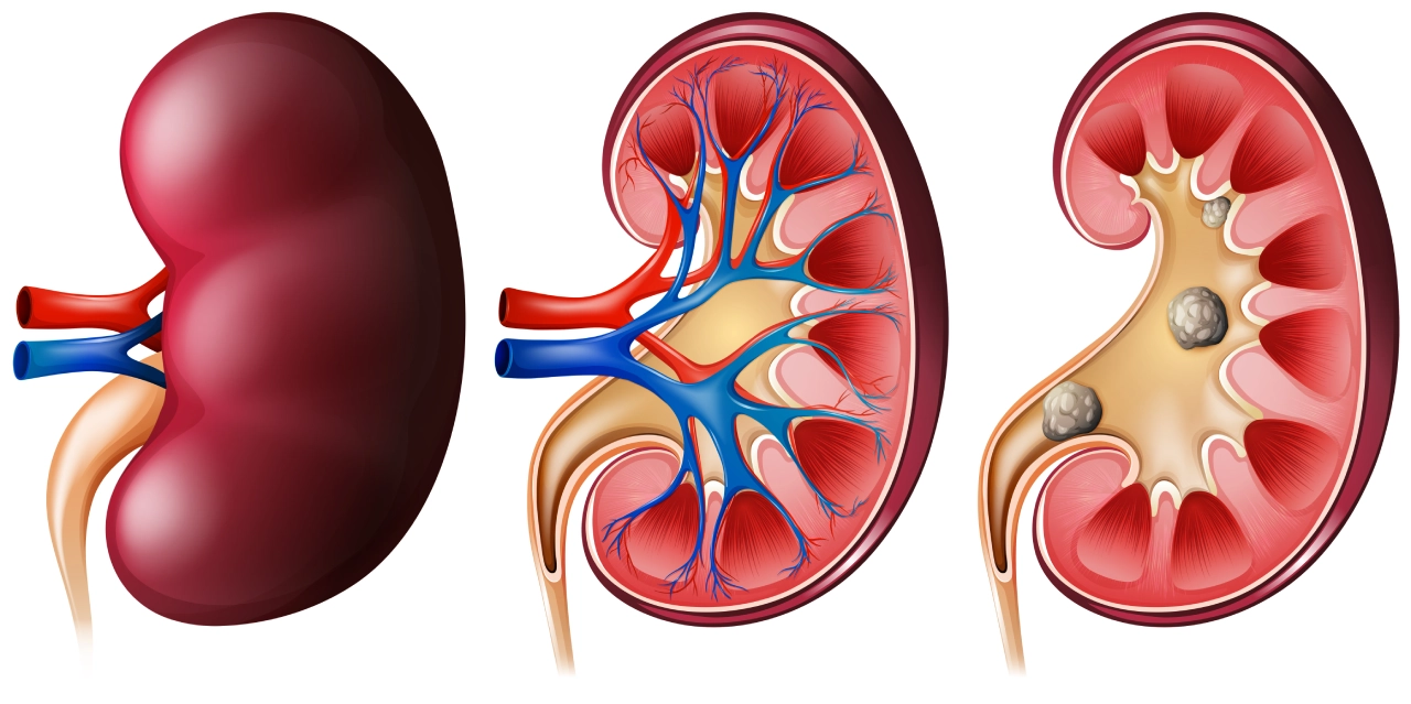 Kidney Stone