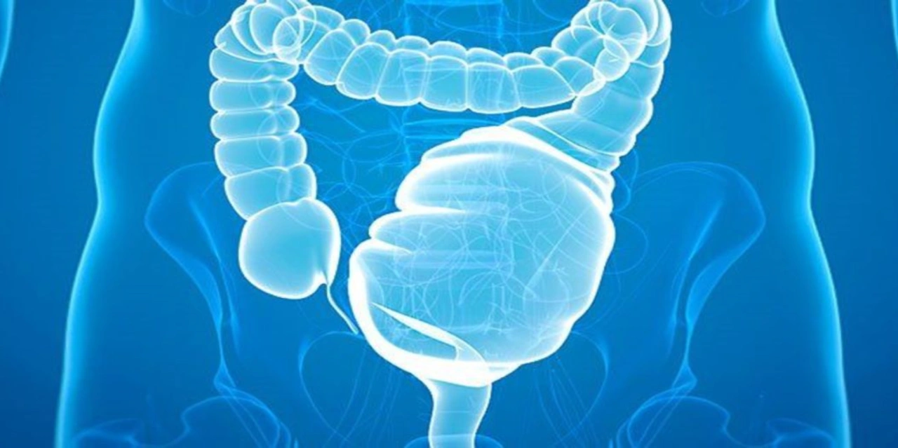 Ulcerative Colitis